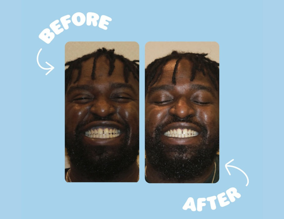 Smyle - Teeth Whitening Kit Refill - Natuurlijke Tandenbleek Refill